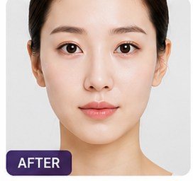 전체 윤곽·볼륨 개선 매선 리프팅 시술 후