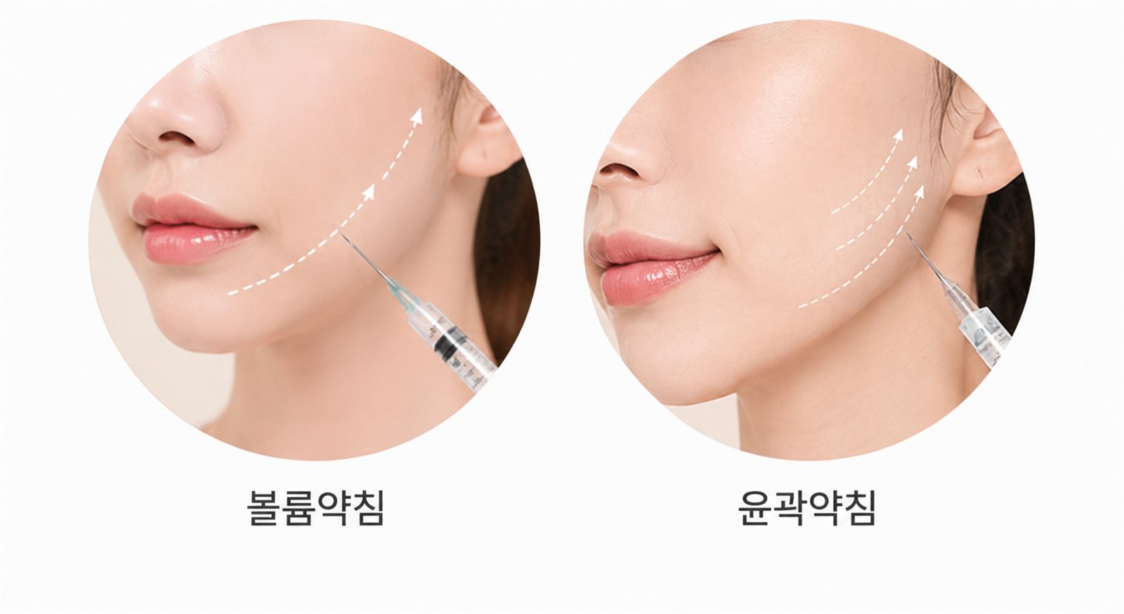 윤곽약침·볼륨약침 윤곽 볼륨 디자인