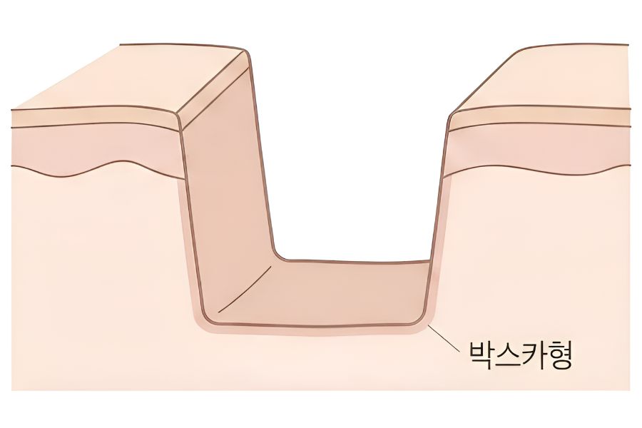 박스형 흉터 일러스트